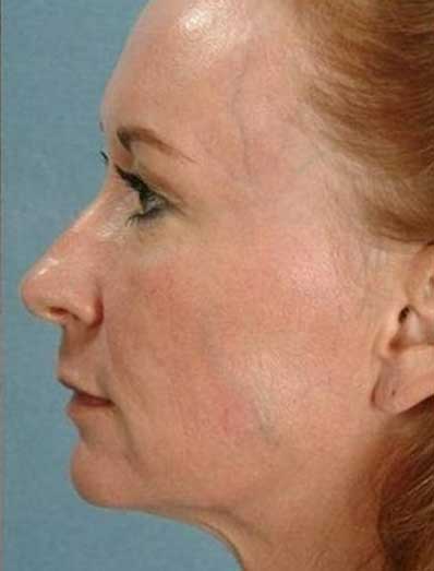 microneedling training