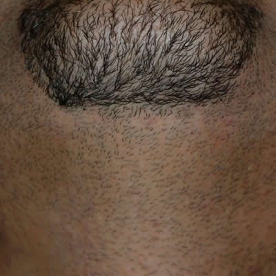 permanent ahir removals