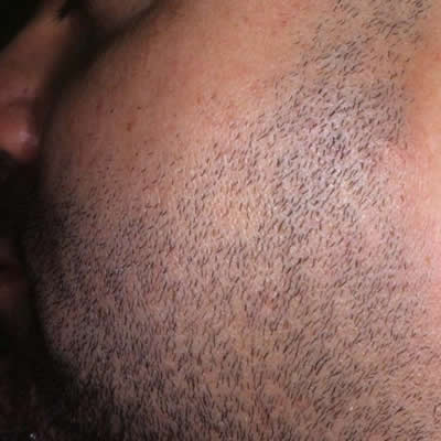 permanent hair removal durban permanent hair removal durban