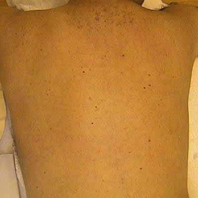 permanent hair removal durban