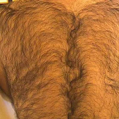 permanent hair removal durban