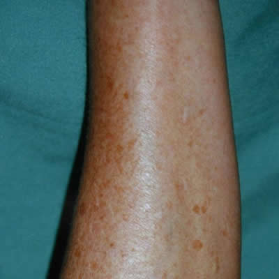 pigmentation treatment pigmentation treatment