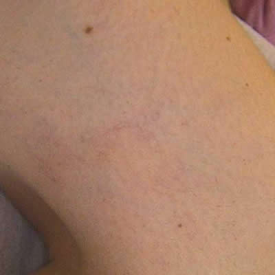 vascular treatments vascular treatments