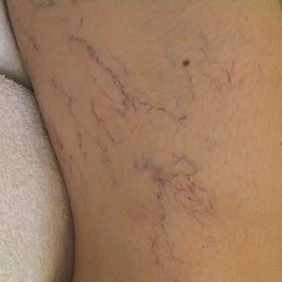 vascular lesion treatments removals vascular lesion treatments removals