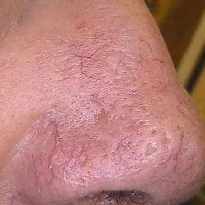 vascular lesion treatments durban south africa vascular lesion treatments durban south africa