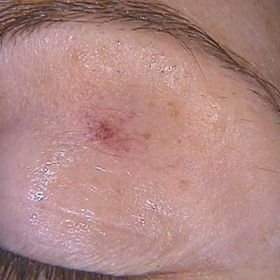 vascular lesion treatments vascular lesion treatments