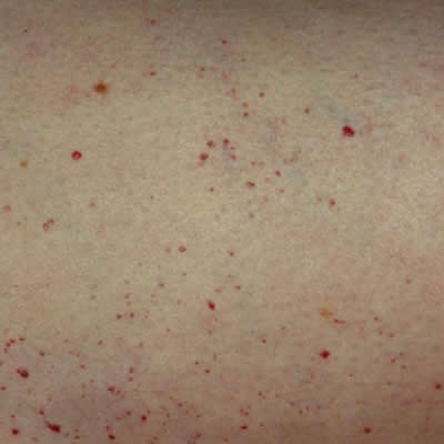 vascular lesion treatments vascular lesion treatments