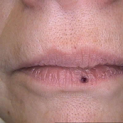 vascular lesion treatments vascular lesion treatments