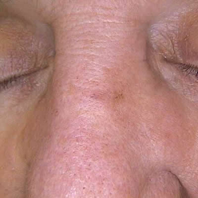 vascular removal durban vascular removal durban