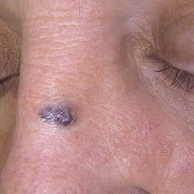 vascular lesion removal durban vascular lesion removal durban