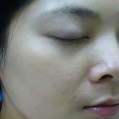 acne durban kzn acne durban kzn