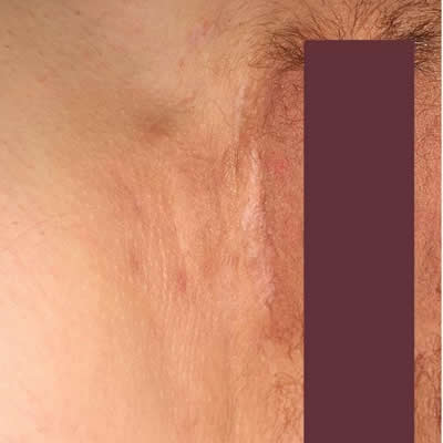 acne acne