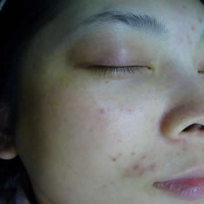 acne durban acne durban