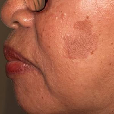 lentigo treatment lentigo treatment