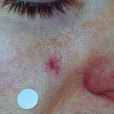 neavus araneus treatments durban neavus araneus treatments durban