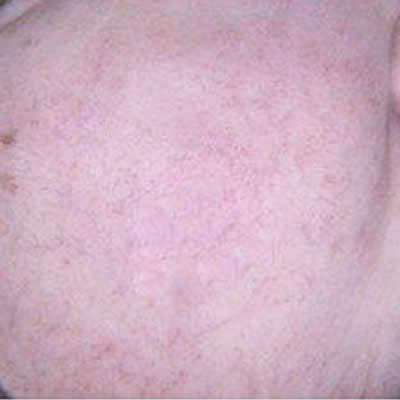 rosacea kzn rosacea kzn