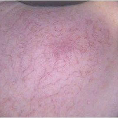 rosacea treatments durban rosacea treatments durban