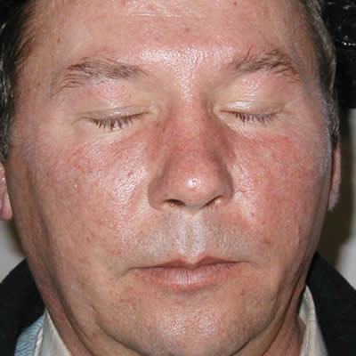 skin rejuvenation treatments skin rejuvenation treatments