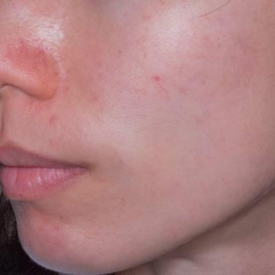 skin rejuvenation durban skin rejuvenation durban