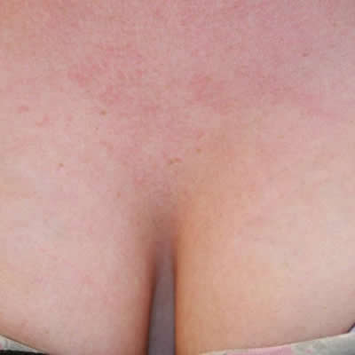 tattoo removals hillcrest