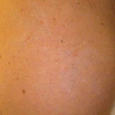 tattoo removing durban