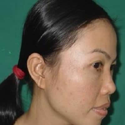 tattoo removal treatment