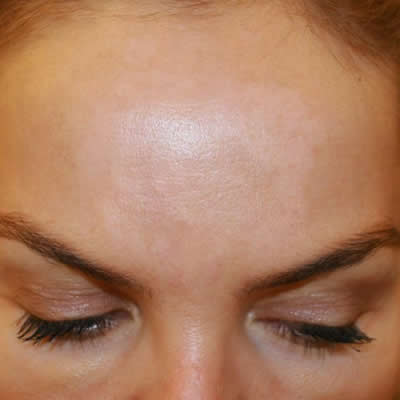 tattoo removal durban