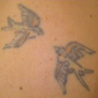 tattoo removals kzn