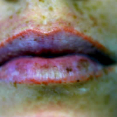 permanent makeup removal