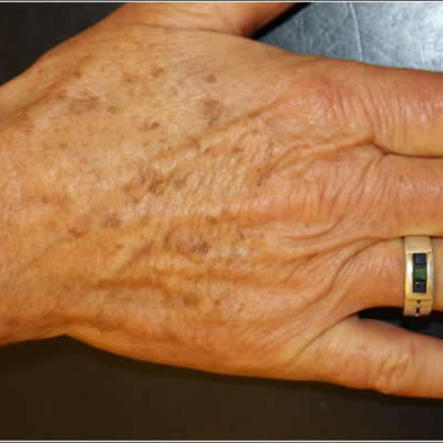 tattoo removal treatments