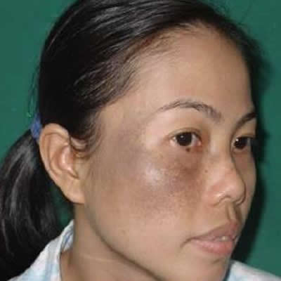 permanent removal of tattoos