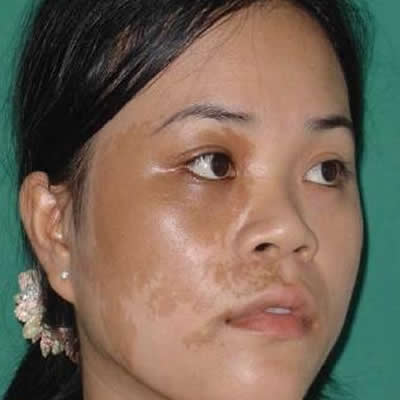 tattoo removals durban