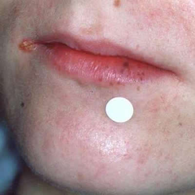 tattoo removal durban south africa