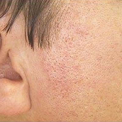 telangiectasia removal telangiectasia removal