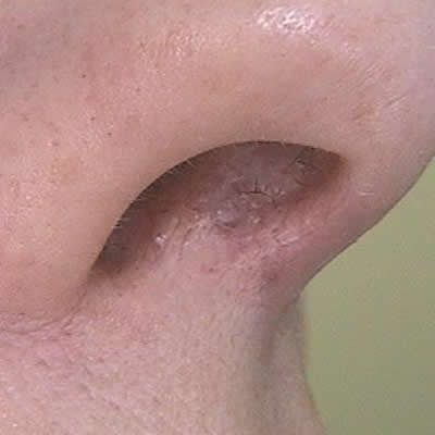 telangiectasia treatments durban telangiectasia treatments durban