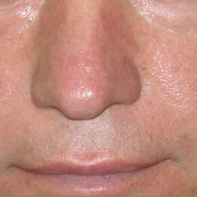 telangiectasia telangiectasia
