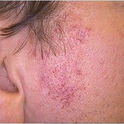 telangiectasia removal durban telangiectasia removal durban