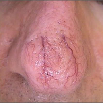 telangiectasia belladerma telangiectasia belladerma