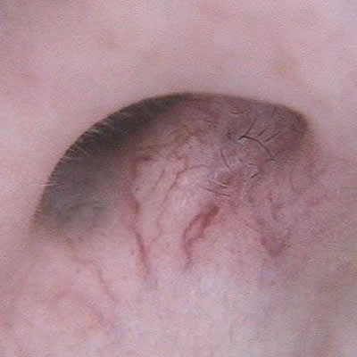 telangiectasia treatments kzn telangiectasia treatments kzn