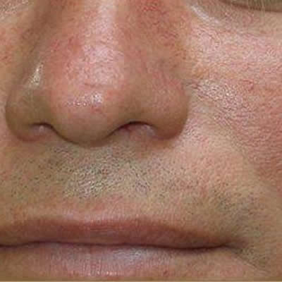 telangiectasia treatments telangiectasia treatments