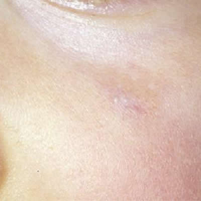 vascular lesion removal durban vascular lesion removal durban