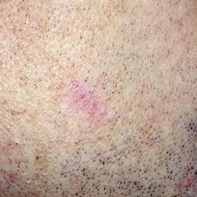 vascular lesion treatments vascular lesion treatments