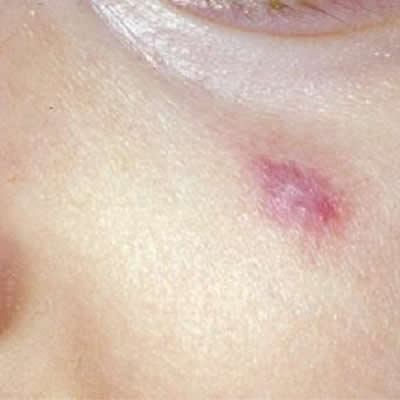 vascular lesion removal durban vascular lesion removal durban