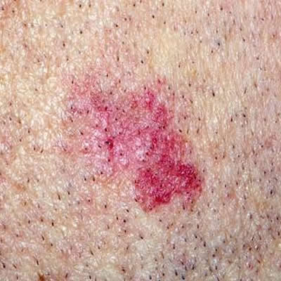 vascular lesions durban vascular lesions durban