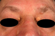 skin treatment