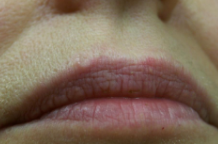 wrinkle removals