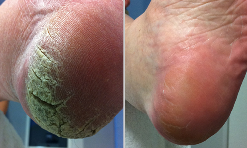 treatment for calluses