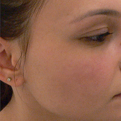 acne treatment durban
