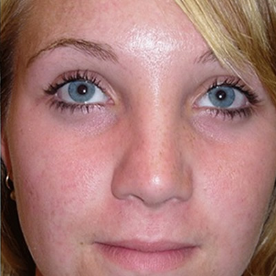 acne treatments