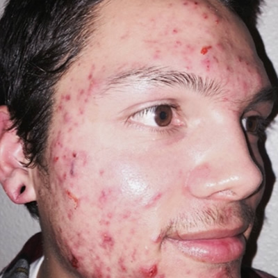 acne treatment
